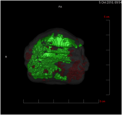 HistoScanning prostata